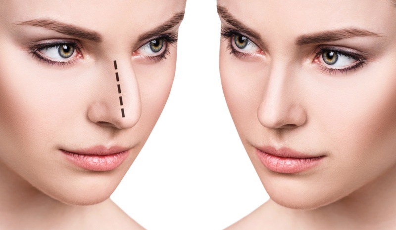 rinoplastia